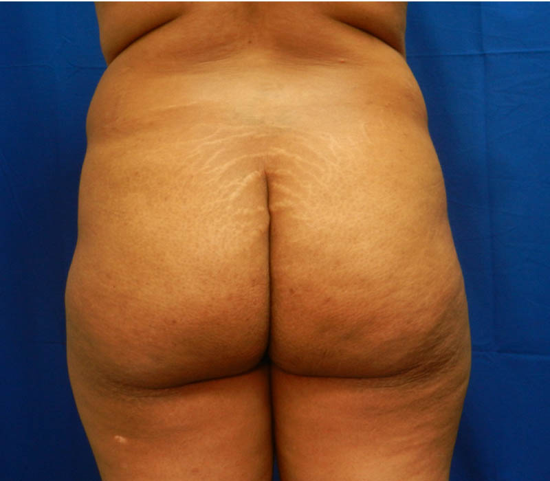 1_0018_Buttock-Aug-Before1.4.JPG
