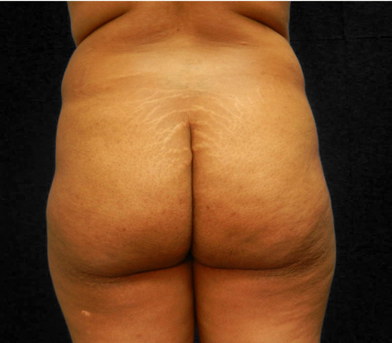 1_0018_Buttock-Aug-Before1.4.JPG.jpg