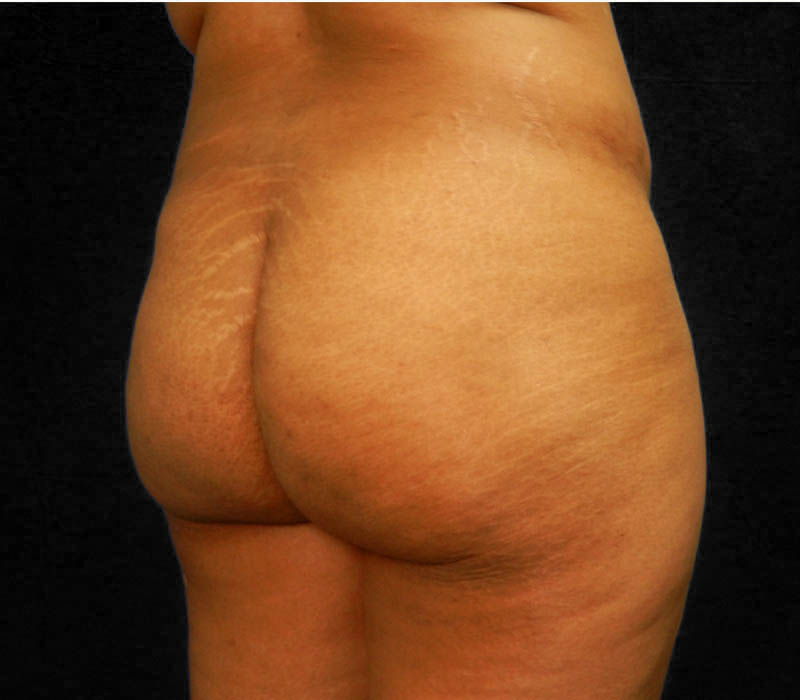 1_0019_Buttock-Aug-Before1.5.JPG.jpg