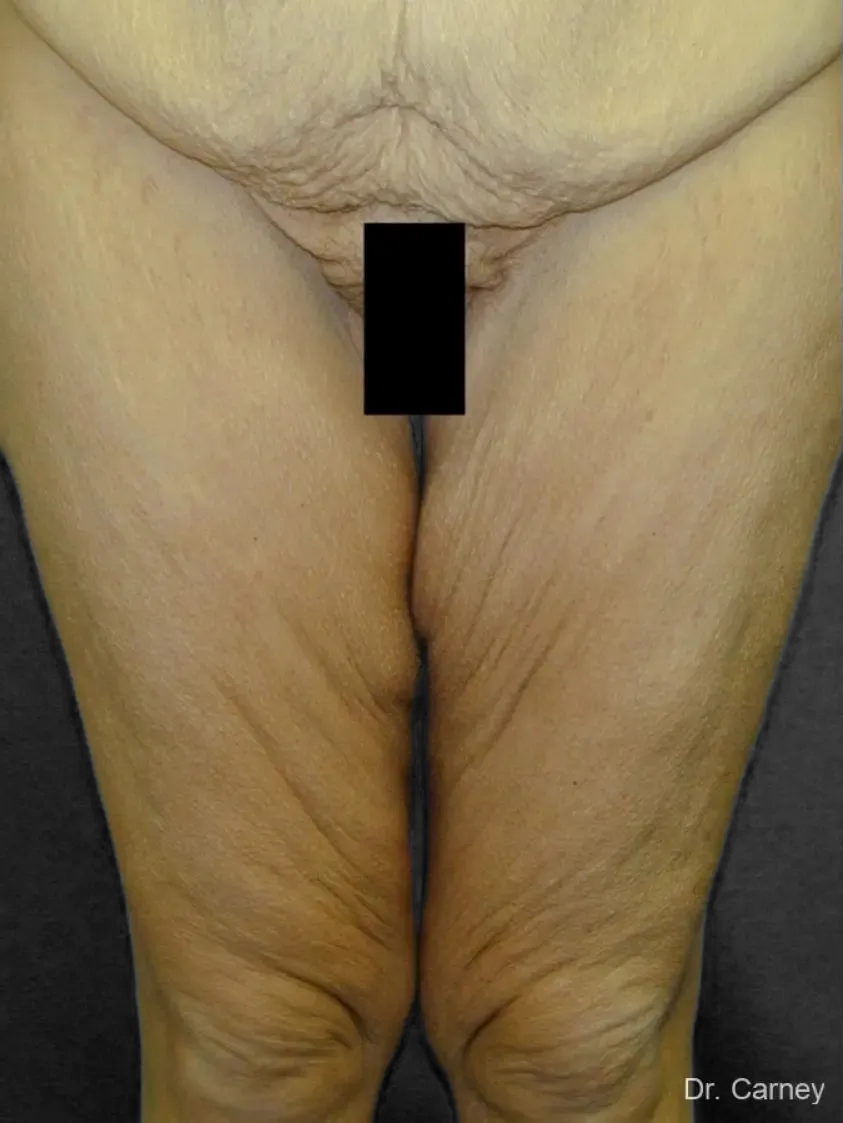 imgi_4_thighlift1.webp