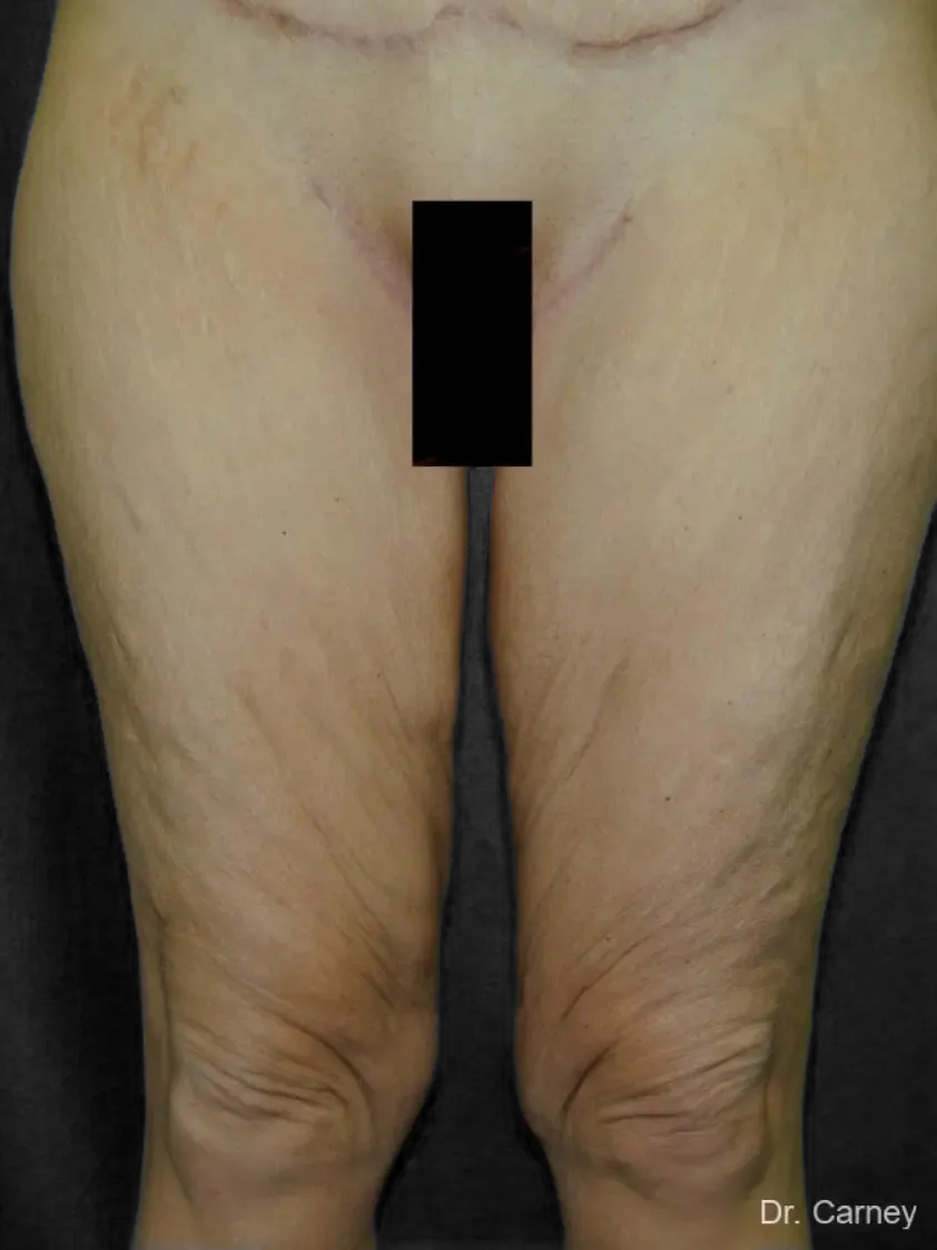 imgi_5_thighlift2.webp