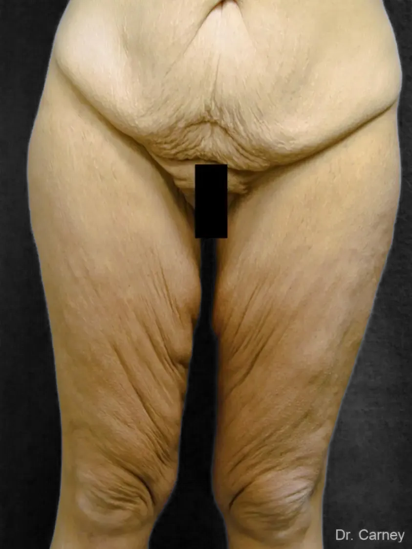 imgi_8_thighlift5.webp