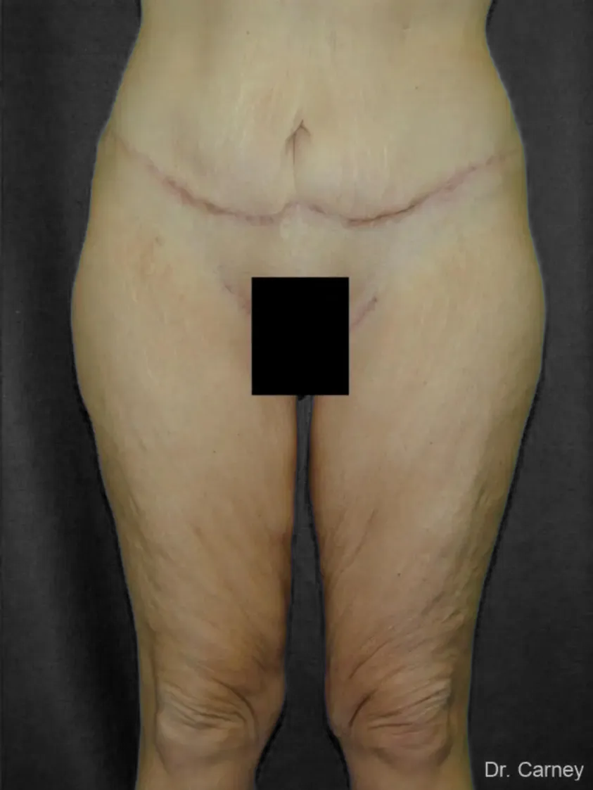 imgi_9_thighlift6.webp