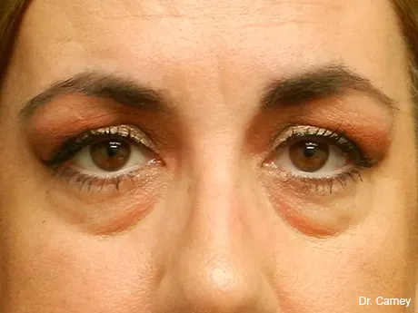 bleph100-460×345-before